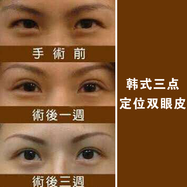 韩式三点定位双眼皮
