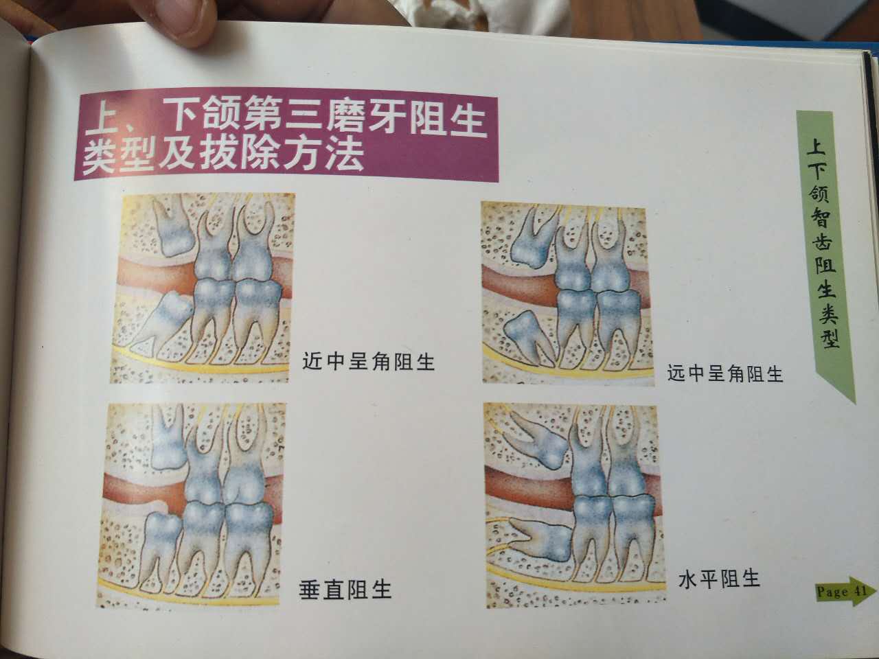 第三磨牙(8 100-500元/个